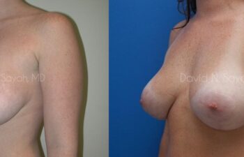 Breast Lift Before and After | Sayah Institute
