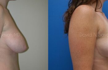 Breast Lift Before and After | Sayah Institute