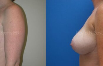 Breast Lift Before and After | Sayah Institute