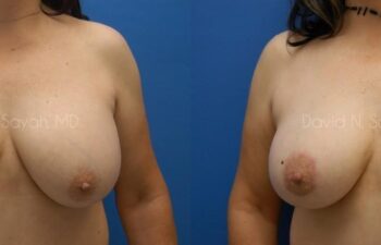 Breast Augmentation And Mastopexy Before and After | Sayah Institute