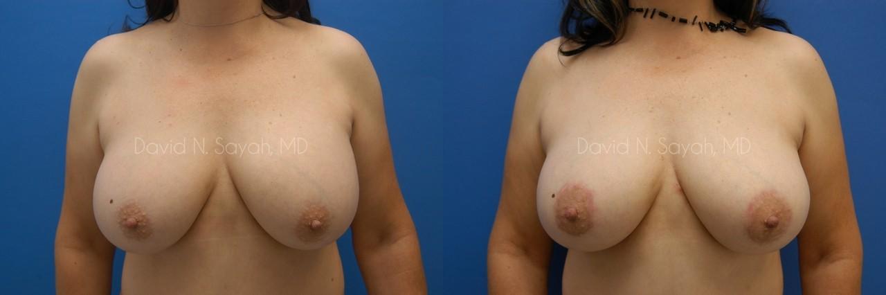 Breast Augmentation And Mastopexy Before and After | Sayah Institute
