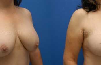 Breast Augmentation And Mastopexy Before and After | Sayah Institute