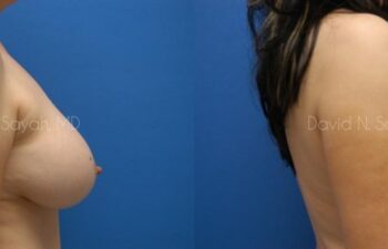 Breast Augmentation And Mastopexy Before and After | Sayah Institute