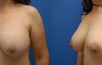 Breast Augmentation And Mastopexy Before and After | Sayah Institute