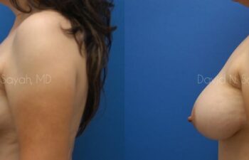 Breast Augmentation And Mastopexy Before and After | Sayah Institute