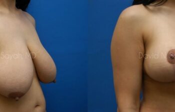 Breast Lift Before and After | Sayah Institute