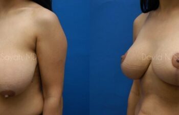 Breast Lift Before and After | Sayah Institute