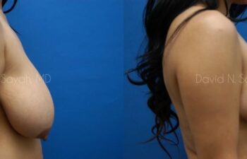 Breast Lift Before and After | Sayah Institute