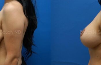 Breast Lift Before and After | Sayah Institute