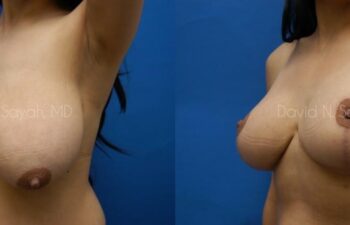 Breast Lift Before and After | Sayah Institute