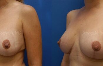 Breast Lift Before and After | Sayah Institute