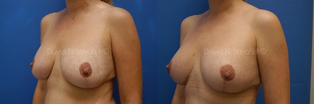 Breast Lift Before and After | Sayah Institute