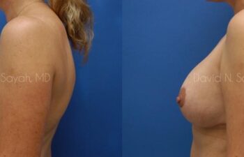 Breast Lift Before and After | Sayah Institute
