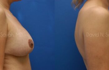 Breast Lift Before and After | Sayah Institute