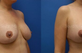 Breast Lift Before and After | Sayah Institute