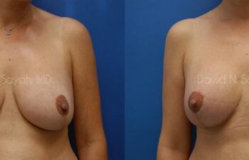 Breast Lift Before and After | Sayah Institute