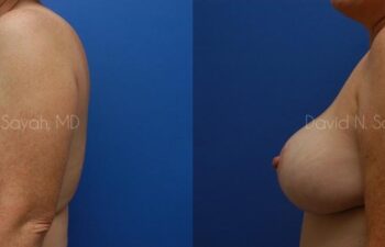 Breast Lift Before and After | Sayah Institute