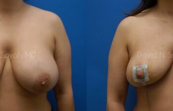 Breast Implant Removal Before and After | Sayah Institute
