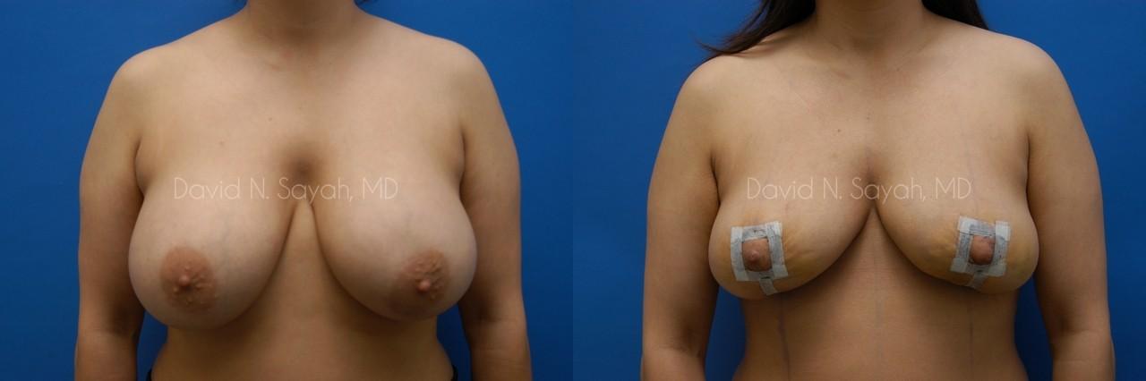 Breast Implant Removal Before and After | Sayah Institute