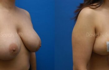Breast Implant Removal Before and After | Sayah Institute