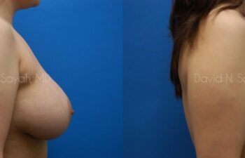 Breast Implant Removal Before and After | Sayah Institute
