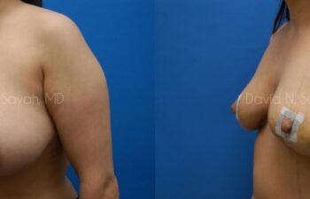 Breast Implant Removal Before and After | Sayah Institute