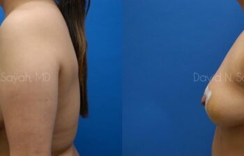 Breast Implant Removal Before and After | Sayah Institute