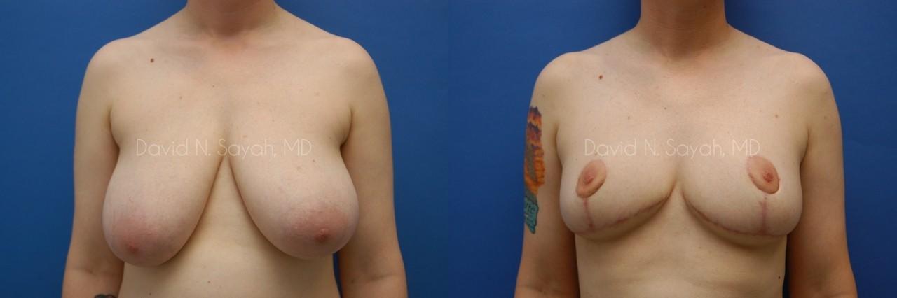 Breast Lift Before and After | Sayah Institute