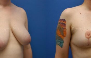 Breast Lift Before and After | Sayah Institute