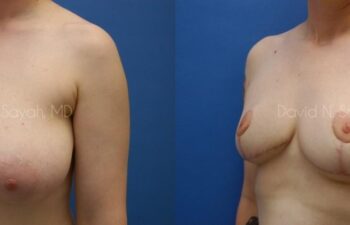 Breast Lift Before and After | Sayah Institute