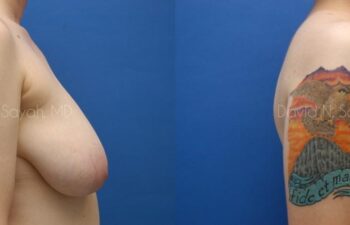 Breast Lift Before and After | Sayah Institute