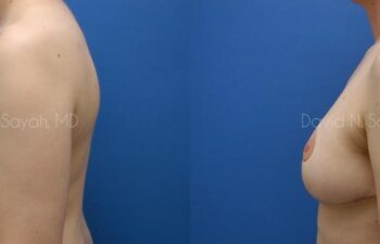 Breast Lift Before and After | Sayah Institute