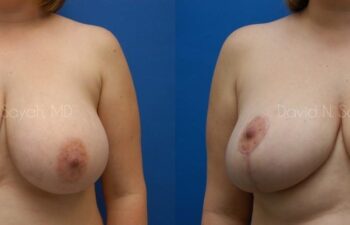 Breast Lift Before and After | Sayah Institute