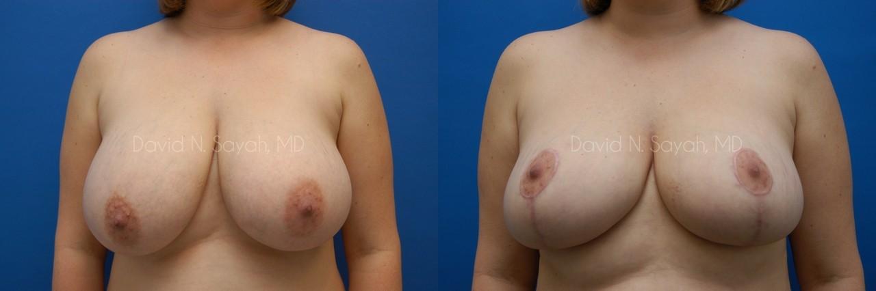 Breast Lift Before and After | Sayah Institute