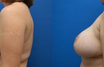 Breast Lift Before and After | Sayah Institute