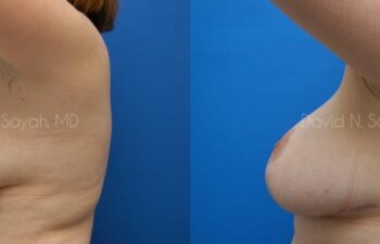 Breast Lift Before and After | Sayah Institute