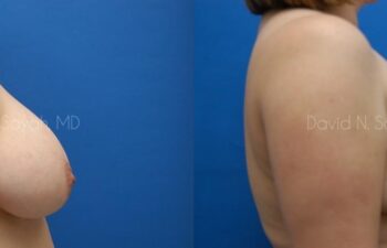 Breast Lift Before and After | Sayah Institute