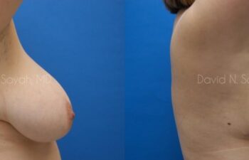 Breast Lift Before and After | Sayah Institute