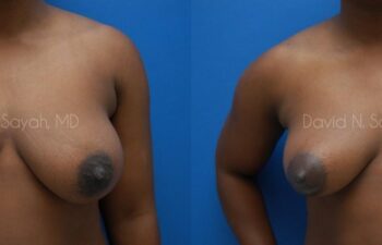 Breast Lift Before and After | Sayah Institute