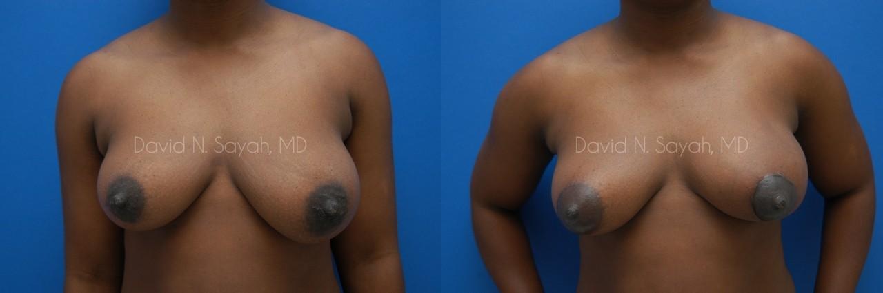 Breast Lift Before and After | Sayah Institute