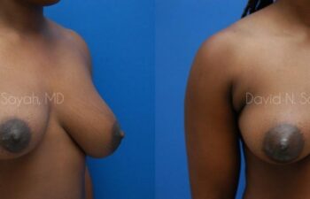 Breast Lift Before and After | Sayah Institute