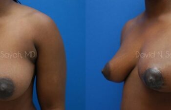 Breast Lift Before and After | Sayah Institute