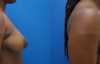 Breast Lift Before and After | Sayah Institute