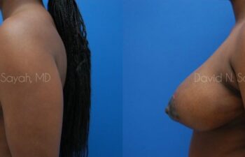 Breast Lift Before and After | Sayah Institute