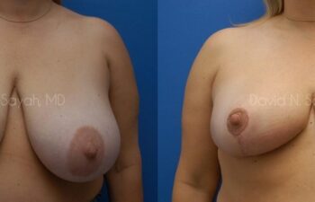 Breast Lift Before and After | Sayah Institute