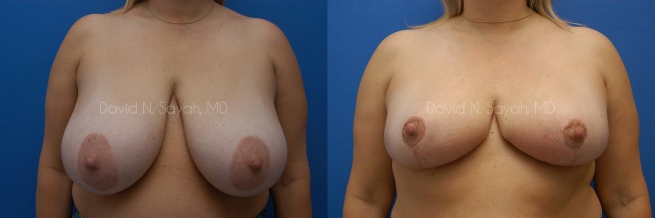 Breast Lift Before and After | Sayah Institute