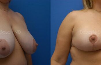 Breast Lift Before and After | Sayah Institute