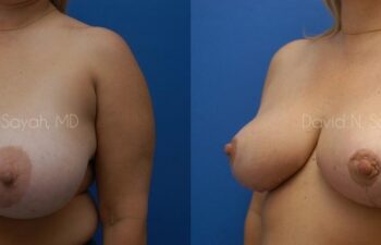 Breast Lift Before and After | Sayah Institute