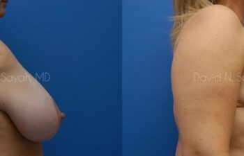 Breast Lift Before and After | Sayah Institute