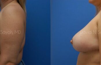 Breast Lift Before and After | Sayah Institute